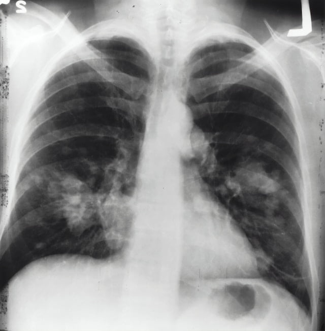 Akciğer Kanseri Belirtileri ve Tedavisi